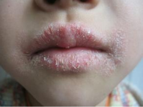 唇炎是怎么引起的 日常护理小方法